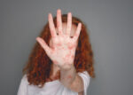 An adult woman with a measles rash on her hand.