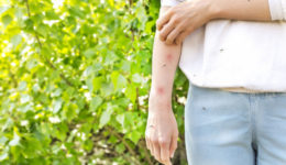 10 home remedies to treat mosquito bites