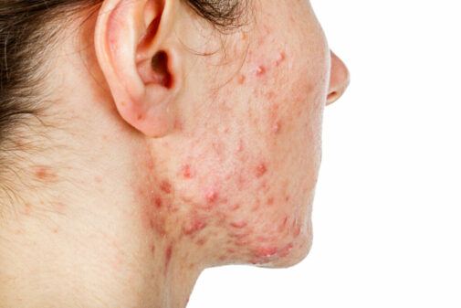 How to get rid of cystic acne