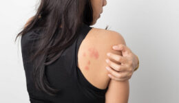 Can this painful rash be triggered by stress?