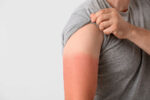 A person revealing a sunburn on their arm.