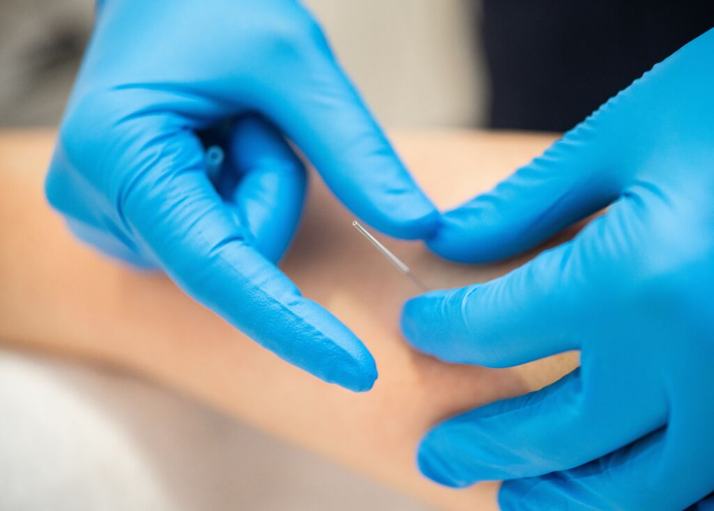 Dry needling can get to the point of your pain health enews