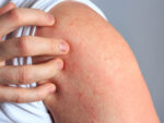 A person itching their hives skin rash.