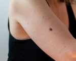 A person's arm with a skin cancer mole.