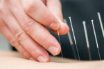 An acupuncturist performs acupuncture on a patient.