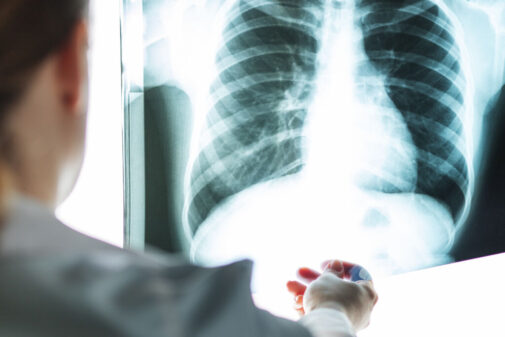 Are you at risk for an interstitial lung disease?