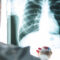 Are you at risk for an interstitial lung disease?