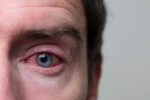 A man has pink eye infection.