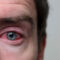 A common, contagious infection that may require treatment