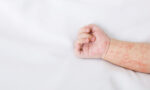 An infant's arm with a measles rash.