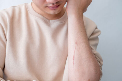 What’s the best treatment for your scar type?