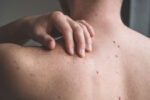 A man performs a self-skin exam to find skin cancer early.
