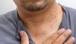 Why you might have skin tags