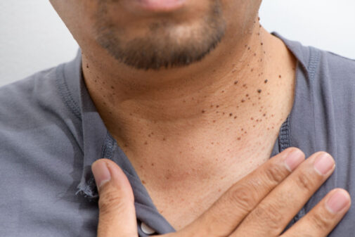 Why you might have skin tags