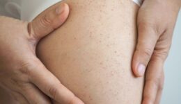 Is petechiae a clear sign of leukemia?