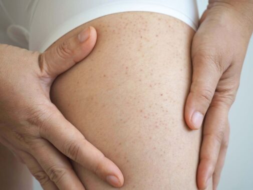 Is petechiae a clear sign of leukemia?