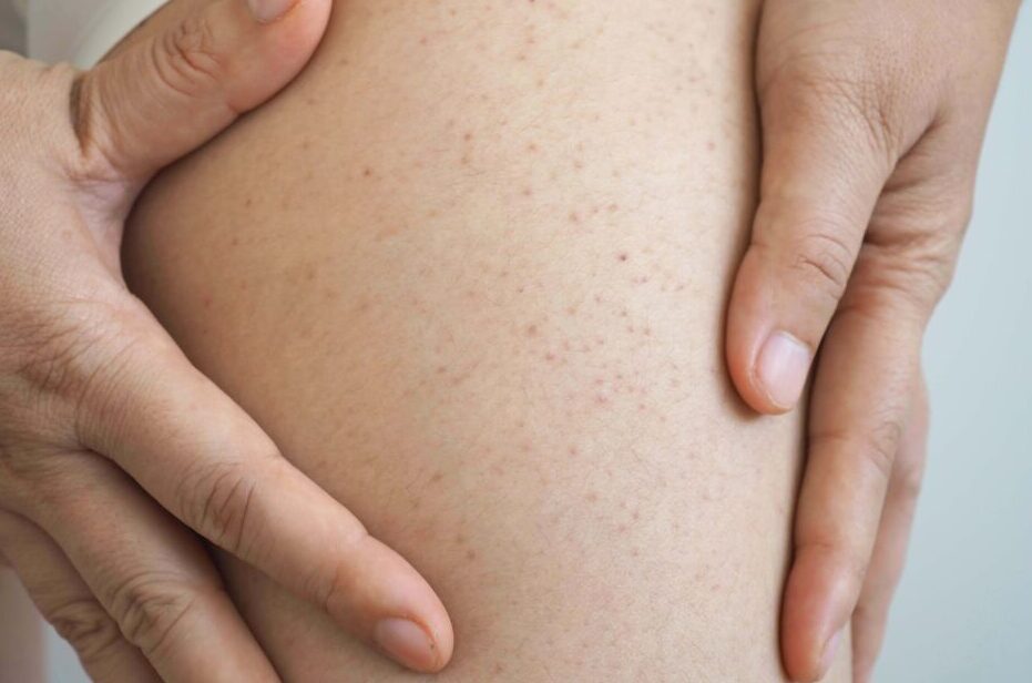 Is petechiae a clear sign of leukemia?
