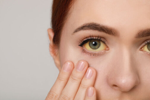 Can adults experience jaundice?