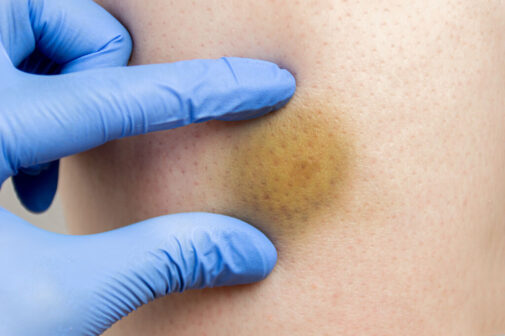Bruising easily? What it could mean for you