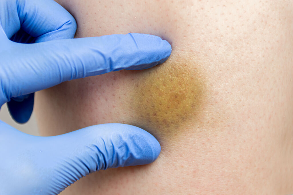 Bruising easily? What it could mean for you