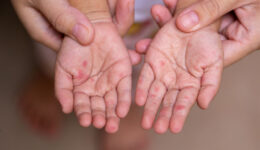 What to know about the surge in hand, foot and mouth disease cases