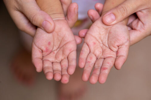 What to know about the surge in hand, foot and mouth disease cases