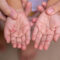 What to know about the surge in hand, foot and mouth disease cases