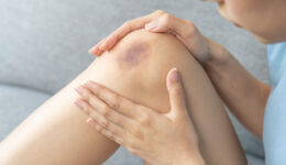 Bruising easily? What it could mean for you