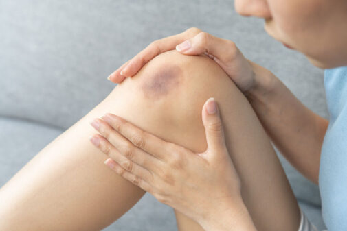 Bruising easily? What it could mean for you