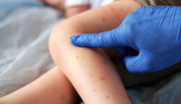 Measles outbreak: What to know to stay protected
