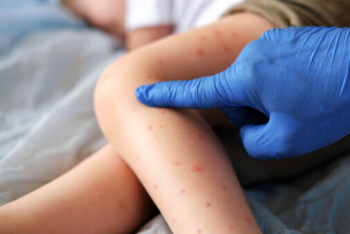 Measles outbreak: What to know to stay protected
