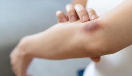 Why a bruise turns different colors