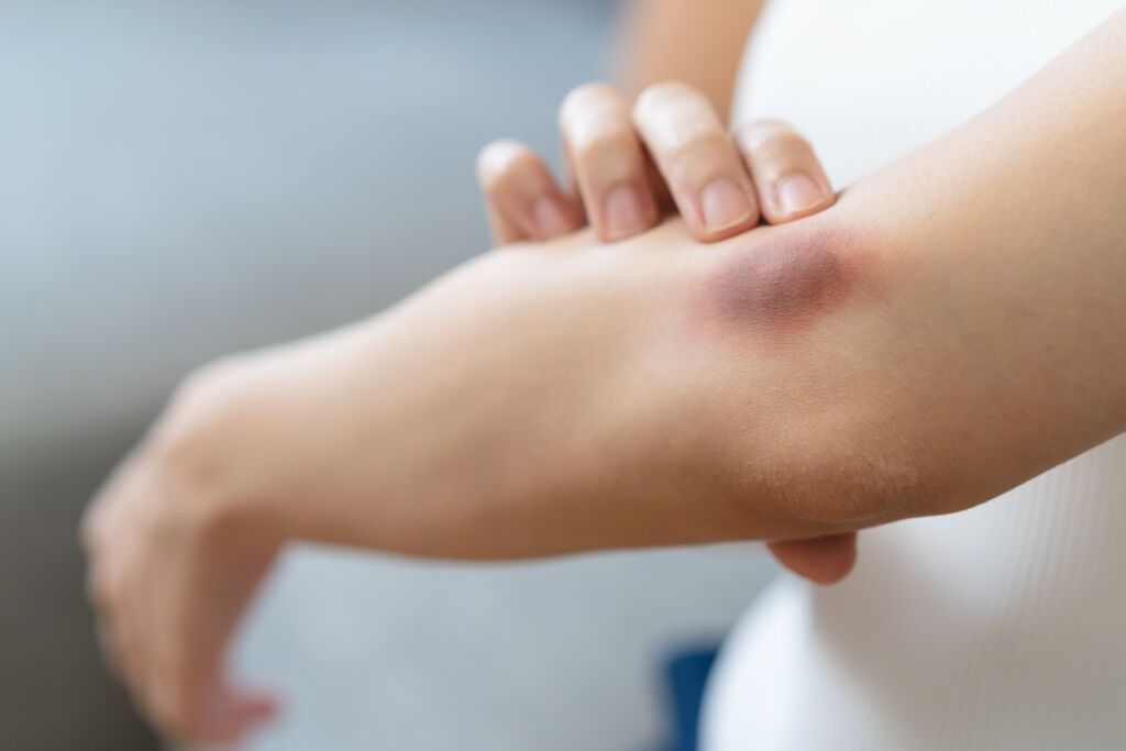 Why a bruise turns different colors